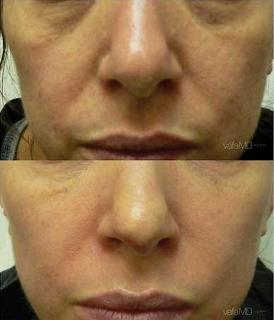 cheek enhancement midtown NYC before after photos